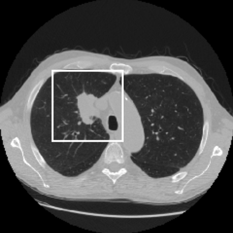 Logo for Lung cancer risk estimation on thorax CT scans - DSB2017 grt123