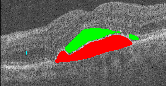 Logo for Segmentation of advanced AMD biomarkers in OCT