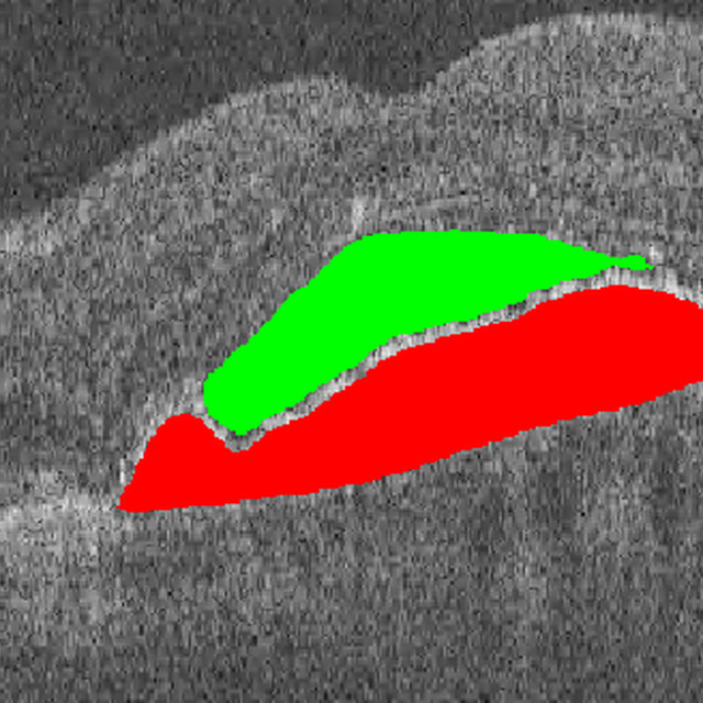Segmentation of advanced AMD biomarkers in OCT Logo