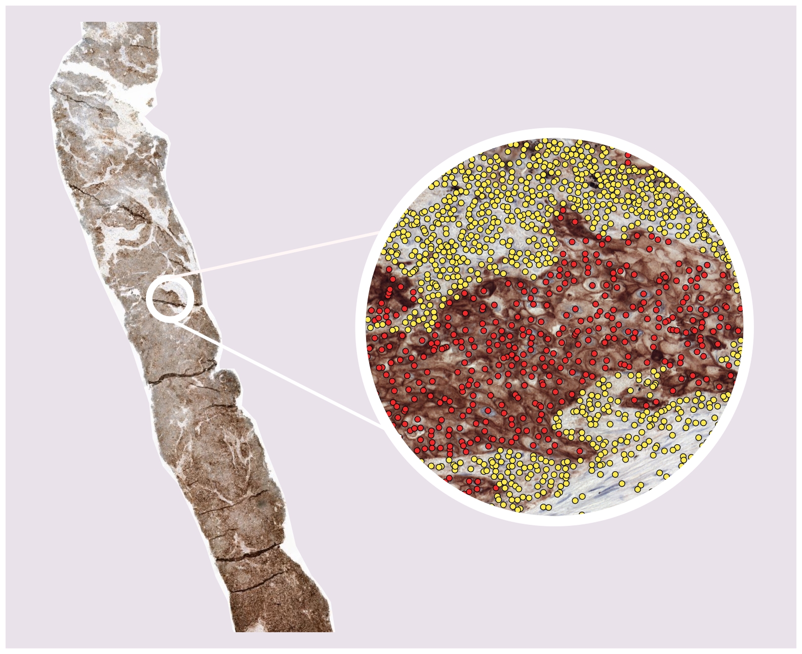 Logo for Tumor proportion score in non-small cell lung cancer